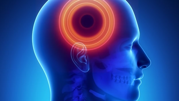 When You Should Worry About Migraine